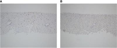 Successful treatment of severe immune checkpoint inhibitor associated autoimmune hepatitis with basiliximab: a case report